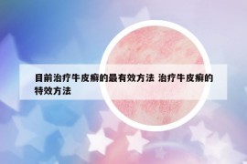 目前治疗牛皮癣的最有效方法 治疗牛皮癣的特效方法