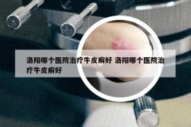 洛阳哪个医院治疗牛皮癣好 洛阳哪个医院治疗牛皮癣好