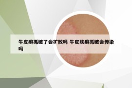 牛皮癣抓破了会扩散吗 牛皮肤癣抓破会传染吗