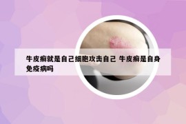 牛皮癣就是自己细胞攻击自己 牛皮癣是自身免疫病吗