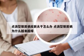 点滴型银屑病皮肤太干怎么办 点滴型银屑病为什么越来越痒
