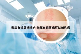乳房有银屑病喂奶 胸部有银屑病可以哺乳吗