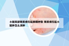 小腿局部银屑病引起脚踝肿胀 银屑病引起小腿肿怎么消肿