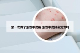 第一次得了急性牛皮癣 急性牛皮鲜会复发吗