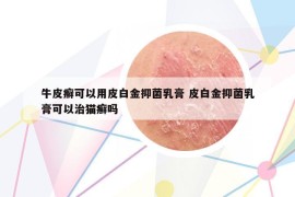 牛皮癣可以用皮白金抑菌乳膏 皮白金抑菌乳膏可以治猫癣吗