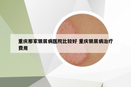 重庆那家银屑病医院比较好 重庆银屑病治疗费用