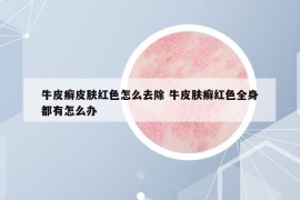 牛皮癣皮肤红色怎么去除 牛皮肤癣红色全身都有怎么办