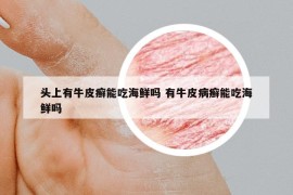 头上有牛皮癣能吃海鲜吗 有牛皮病癣能吃海鲜吗