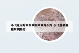 小飞蓬治疗银屑病的效果好不好 小飞蓬草治银屑病用方