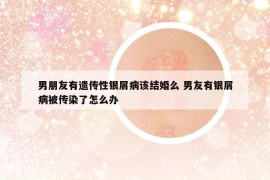 男朋友有遗传性银屑病该结婚么 男友有银屑病被传染了怎么办
