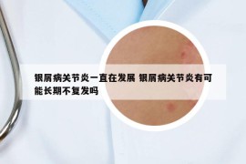 银屑病关节炎一直在发展 银屑病关节炎有可能长期不复发吗