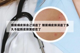 银屑病皮损自己消退了 银屑病皮损消退了多久不起新皮损算痊愈了