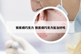 银屑病巧克力 银屑病巧克力能治好吗
