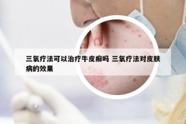 三氧疗法可以治疗牛皮癣吗 三氧疗法对皮肤病的效果