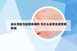 染头发能引起银屑病吗 为什么染发会诱发银屑病