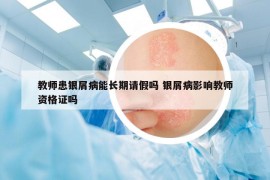 教师患银屑病能长期请假吗 银屑病影响教师资格证吗