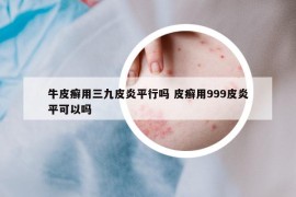 牛皮癣用三九皮炎平行吗 皮癣用999皮炎平可以吗