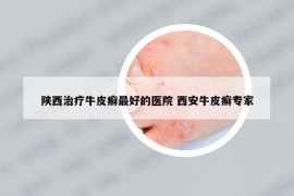 陕西治疗牛皮癣最好的医院 西安牛皮癣专家