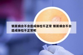 银屑病会不会造成体检不正常 银屑病会不会造成体检不正常呢