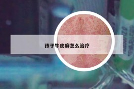 孩子牛皮癣怎么治疗