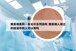 银屑病用同一条毛巾会传染吗 银屑病人用过的搓澡巾别人可以用吗