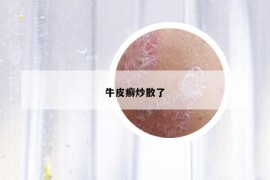 牛皮癣炒散了