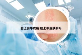 脸上会牛皮癣 脸上牛皮肤癣吗