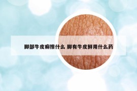 脚部牛皮癣擦什么 脚有牛皮鲜用什么药