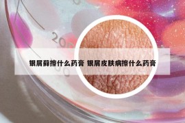 银屑藓擦什么药膏 银屑皮肤病擦什么药膏