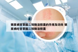 银屑病甘草酸二铵肠溶胶囊的作用及功效 银屑病吃甘草酸二铵肠溶胶囊
