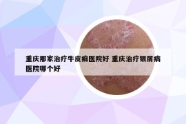 重庆那家治疗牛皮癣医院好 重庆治疗银屑病医院哪个好