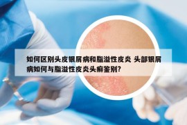 如何区别头皮银屑病和脂溢性皮炎 头部银屑病如何与脂溢性皮炎头癣鉴别?