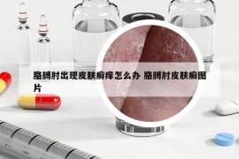 胳膊肘出现皮肤癣痒怎么办 胳膊肘皮肤癣图片