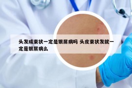 头发成束状一定是银屑病吗 头皮束状发就一定是银屑病么