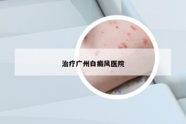 治疗广州白癜风医院