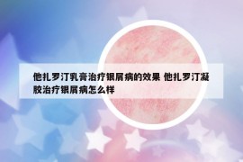 他扎罗汀乳膏治疗银屑病的效果 他扎罗汀凝胶治疗银屑病怎么样