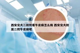 西安交大二附院看牛皮癣怎么杨 西安交大附属二院牛皮癣吧