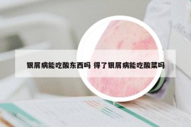 银屑病能吃酸东西吗 得了银屑病能吃酸菜吗