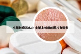 小腿长癣怎么办 小腿上长癣的图片有哪些