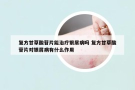 复方甘草酸苷片能治疗银屑病吗 复方甘草酸苷片对银屑病有什么作用