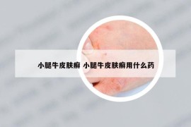 小腿牛皮肤癣 小腿牛皮肤癣用什么药