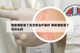 银屑病感冒了会怎样治疗最好 银屑病感冒了吃什么药