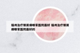 福州治疗银屑病哪家医院最好 福州治疗银屑病哪家医院最好的