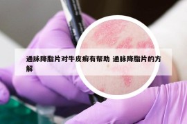 通脉降脂片对牛皮癣有帮助 通脉降脂片的方解