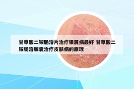 甘草酸二铵肠溶片治疗银屑病最好 甘草酸二铵肠溶胶囊治疗皮肤病的原理