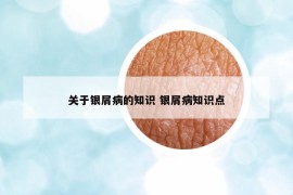 关于银屑病的知识 银屑病知识点