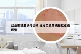红皮型银屑病传染吗 红皮型银屑病和红皮病区别