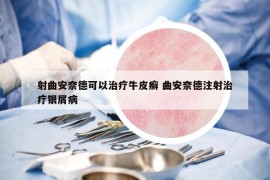 射曲安奈德可以治疗牛皮癣 曲安奈德注射治疗银屑病