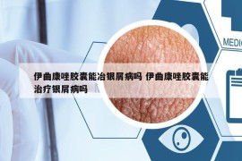 伊曲康唑胶囊能冶银屑病吗 伊曲康唑胶囊能治疗银屑病吗
