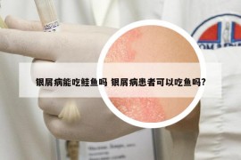 银屑病能吃鲑鱼吗 银屑病患者可以吃鱼吗?